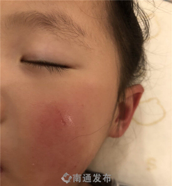 真皮层损伤无法痊愈,涉事家长和园方称走法律程序|南通发布