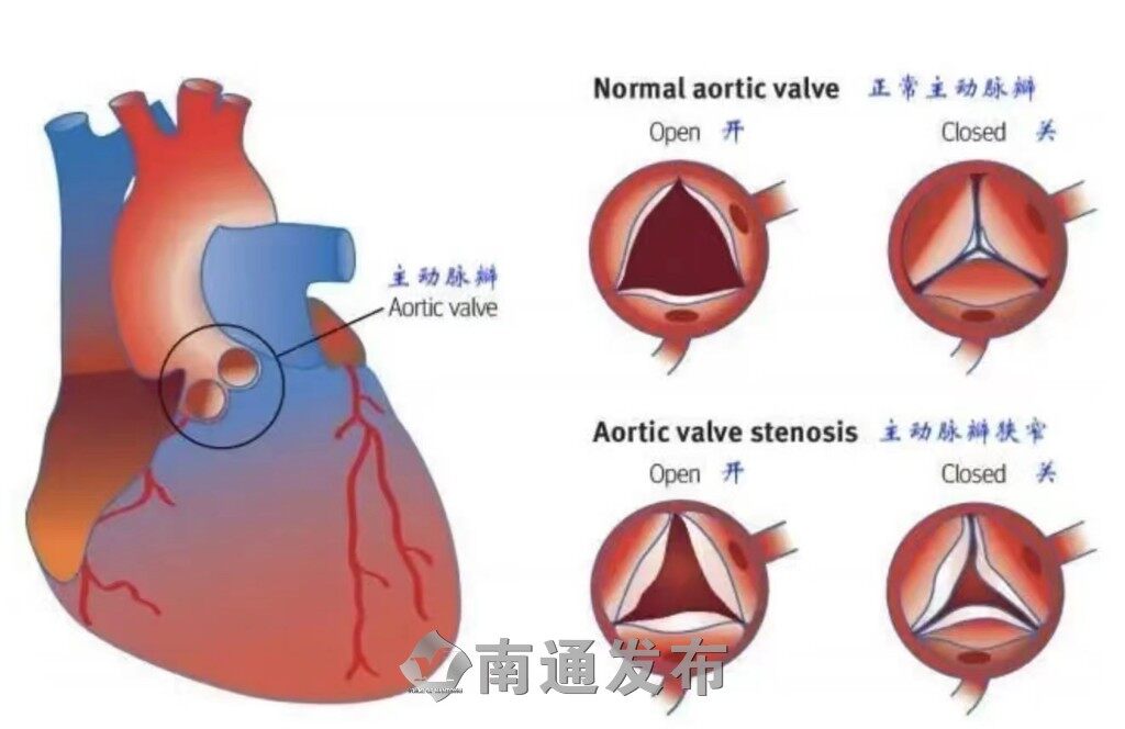 主动脉瓣上缩窄图片